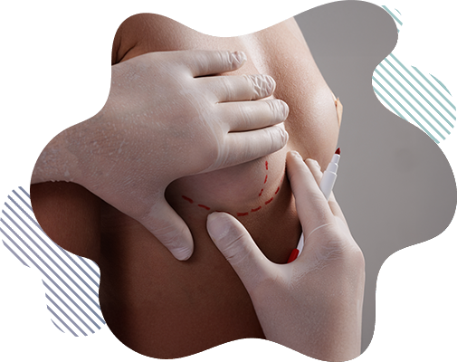 Mamoplastia en Manta Ecuador - Aumento de Senos Silueta Divina